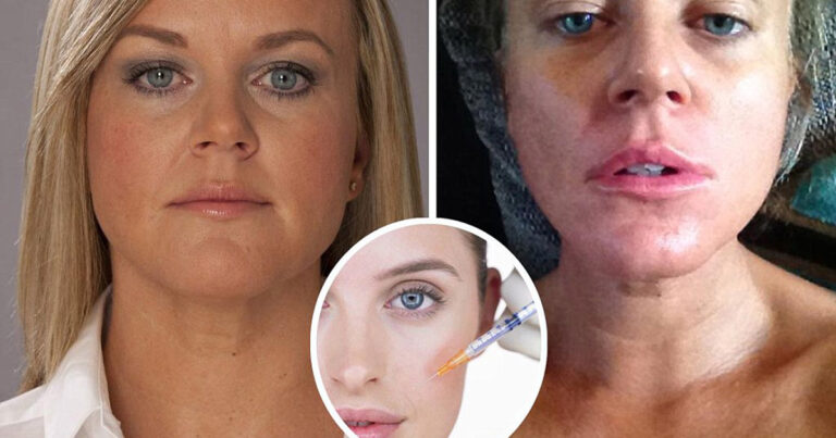 Ett kryddmått av ren Botox skulle ta död på hela svenska befolkningen – nu varnar forskare för farorna